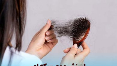 ریزش موی سکه ای چیست
