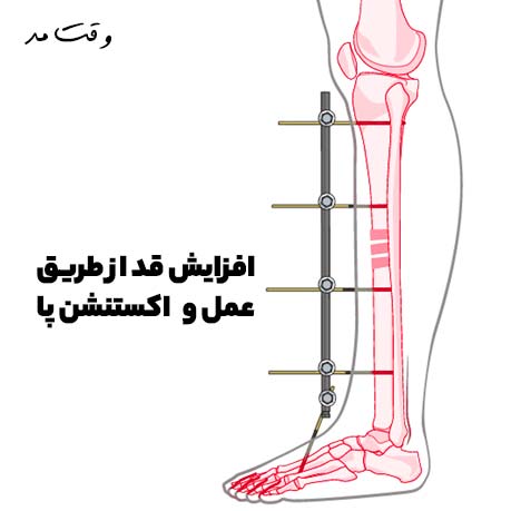 تصویری از عمل اکستنشن پا که باعث افزایش قد می شود را مشاهده می کنید.