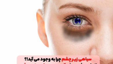 سیاهی و کبودی زیر چشم