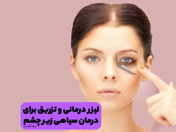 لیزر درمانی یکی از روش های درمان سیاهی و کبودی زیر چشم است.
