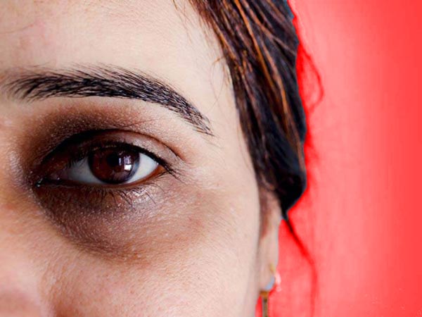 گودی و سیاهی زیر چشم زنانه