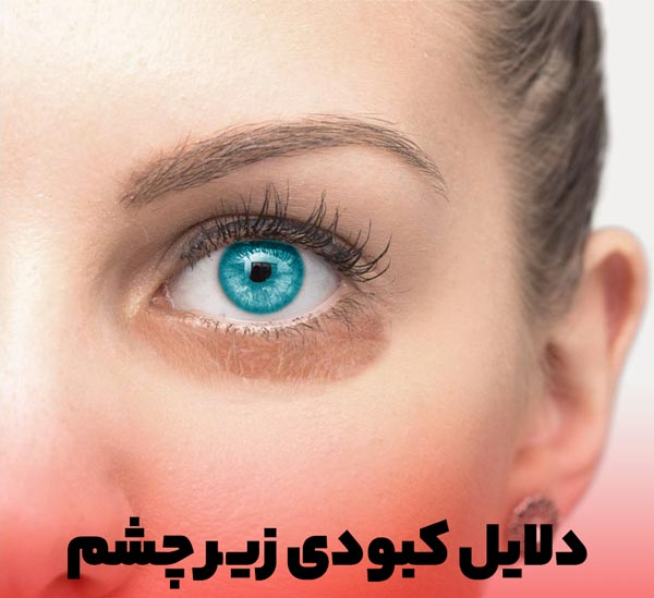 کبودی و سیاهی زیر چشم در بانوان