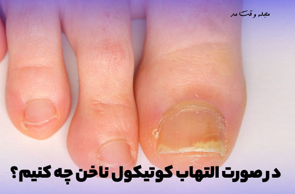 تصویری از کوتیکول ناخن که ملتهب شده است