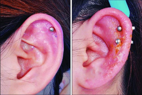 عفونت گوش بر اثر پیرسینگ یا سوراخ کردن گوش