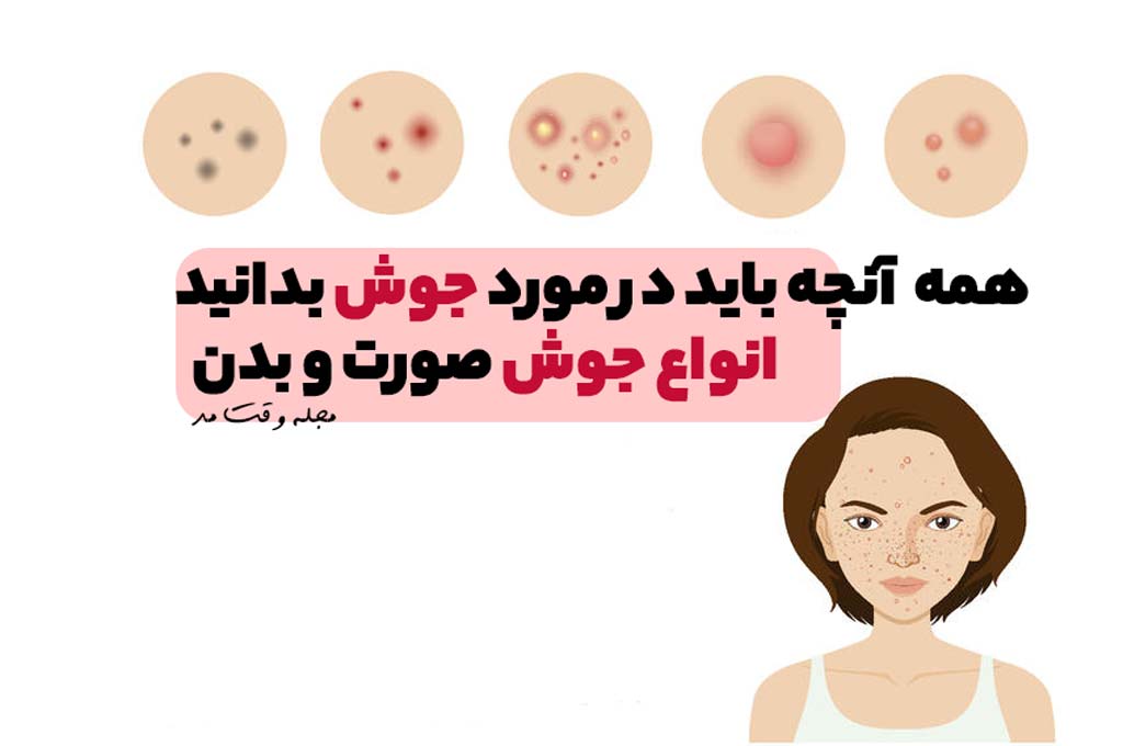 عکس انواع جوش صورت