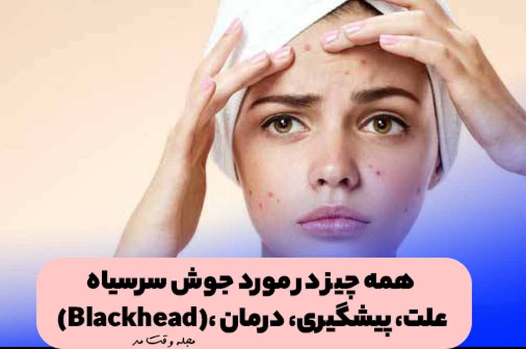 جوش سرسیاه صورت