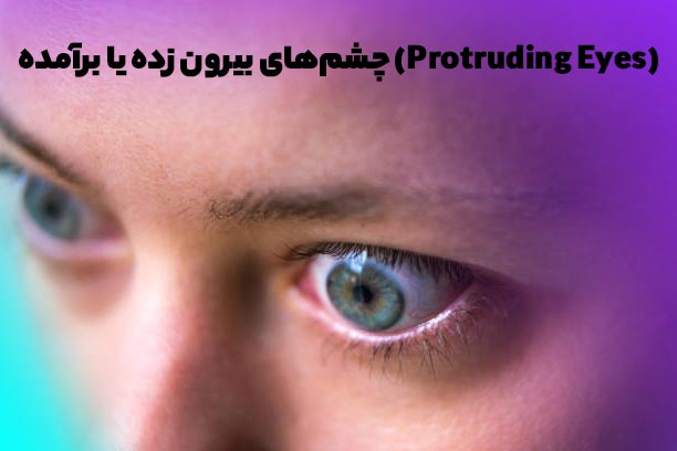 مدل چشم از حدقه بیرون زده یا برآمده
