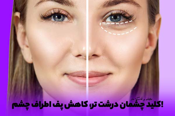 تصویری از قبل و بعد کاهش پف چشم و تاثیر آن بر درشتی چشم