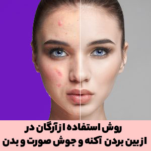 تصویری از قبل و بعد از استفاده روغن آرگان برای رفع آکنه و جوش صورت، یکی از مهمترین خواص روغن آرگان برای پوست از بین بردن آکنه است