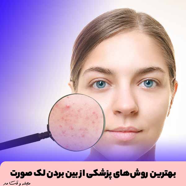 شناسایی بهترین روش های پزشکی برای از بین بردن و درمان لک صورت