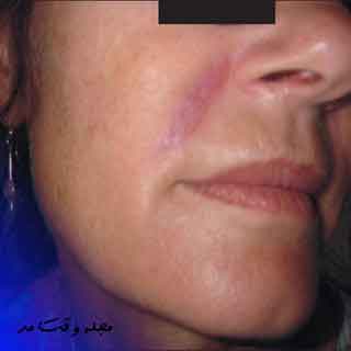 تصویری از عوارض انجام فیلر یا تزریق ژل بر روی صورت را مشاهده می‌کنید.