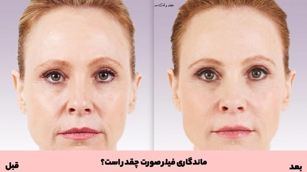 تصویری از قبل و بعد از انجام فیلر یا ژل صورت
