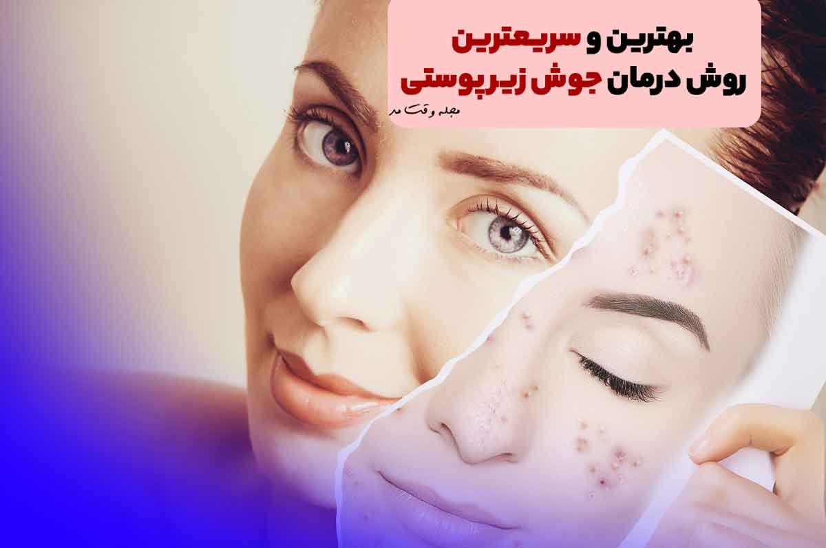 درمان جوش زیر پوستی صورت