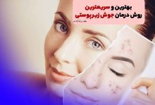درمان جوش زیر پوستی صورت