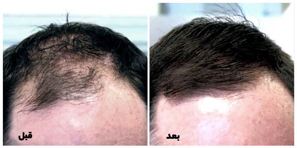 عکس قبل و بعد از تزریق فیلر مو را مشاهده می‌کنید.