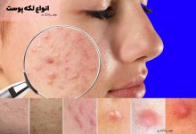 انواع لکه پوست، با ویژگی ها و علت ایجاد لک پوست آشنا شوید