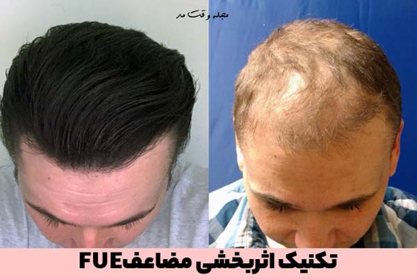 تصویری از قبل و بعد از کاشت مو