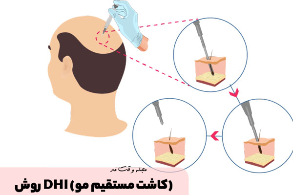  پیوند مو DHI به وسیله یک قلم انجام می‌شود.