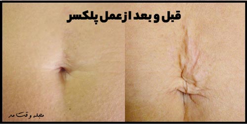 عکس قبل و بعد از انجام پلکسر پوست