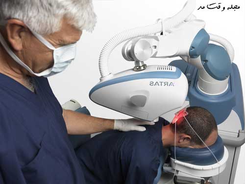 کاشت مو با ریات پیشرفته ARTAS iX