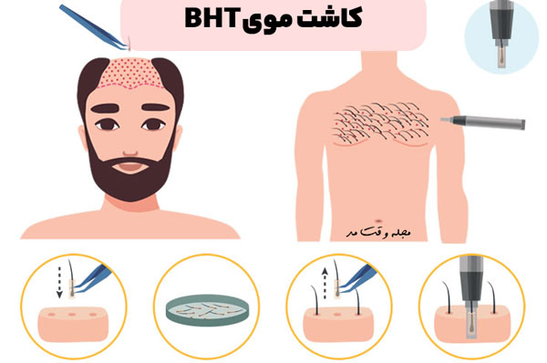 روش کاشت مو سر از طریق مو بدن و سینه
