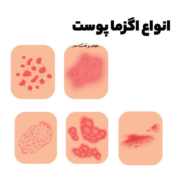 اگر اگزما درمان نشود چه میشود؟