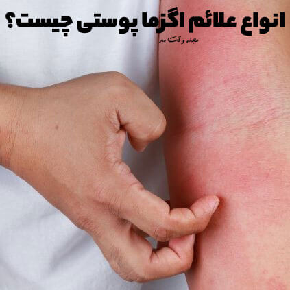 انواع علائم اگزما پوستی