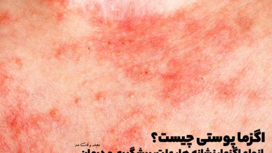 اگزما پوستی چیست؟ انواع اگزما، نشانه ها، علت، پیشگیری و درمان اگزمای پوست