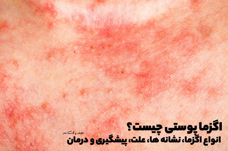 اگزما پوستی چیست؟ انواع اگزما، نشانه ها، علت، پیشگیری و درمان اگزمای پوست