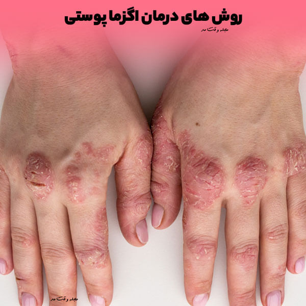 روش پیشگیری از اگزمای پوستی