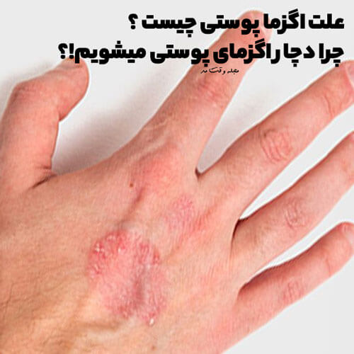 علت اگزما پوستی میتواند به علت های مختلفی مانند، ژنتیک، استرس، عوامل حساسیت زای پوستی باشد.