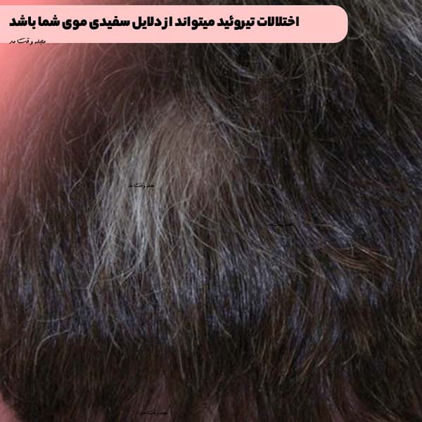 اختلالات تیروئید میتواند از دلایل سفیدی موی شما باشد