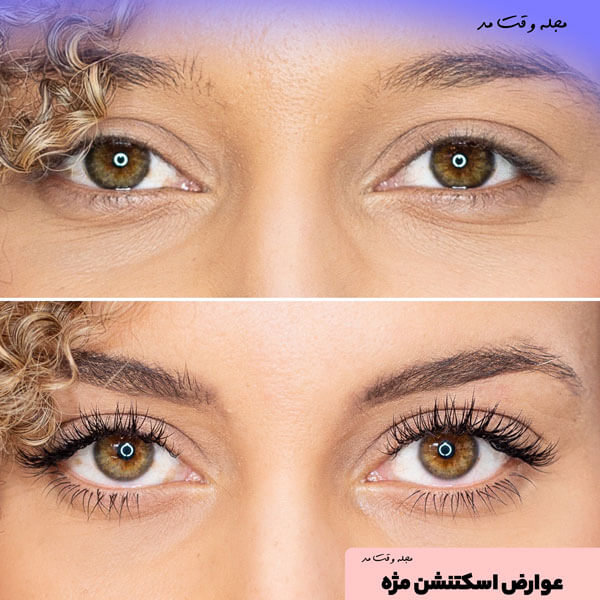 اگر مواد اکستنشن بی کیفیت و روش کاشت مژه غلط باشد، به مژه ها و حتی چشم میتواند آسیب های جدی بزند