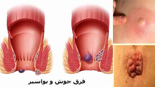فرق جوش مقعدی با بواسیر