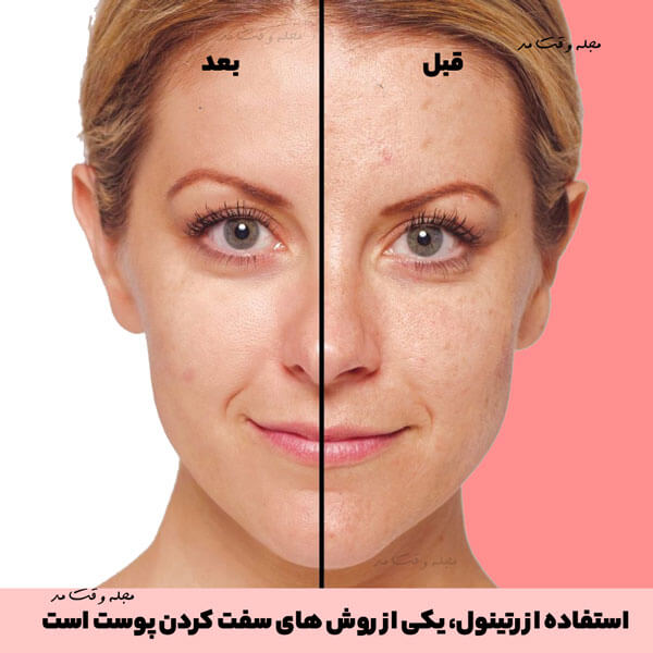 یکی از روش های سفت کردن پوست، استفاده از رتینول (retinol) است