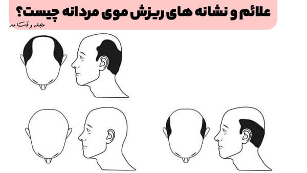 علائم و نشانه های ریزش موی مردانه