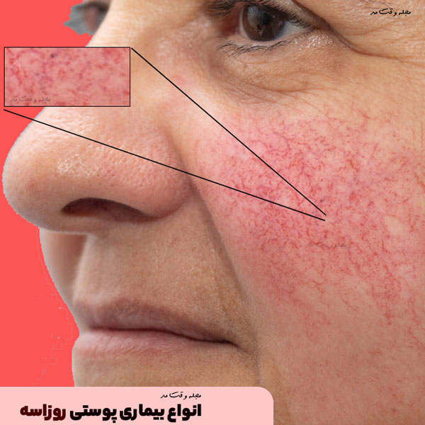 4 نوع بیماری پوستی روزاسه وجود دارد