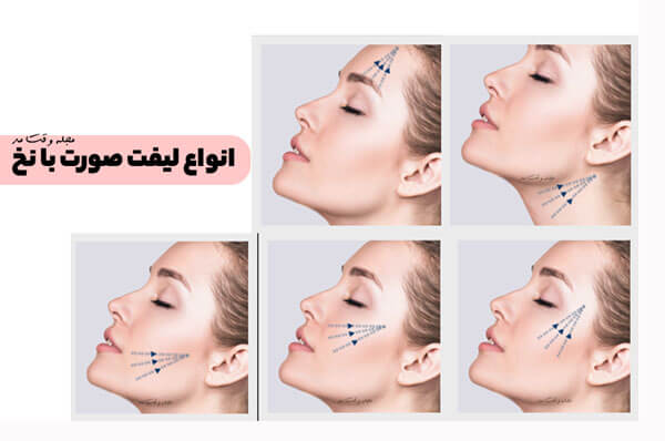 انواع روش لیفت صورت با استفاده از نخ