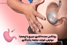 بوتاکس معده! لاغری سریع یا توهم؟ عوارض، فواید، نیازها، ماندگاری