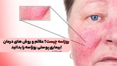 روزاسه چیست؟ علائم و روش های درمان بیماری پوستی روزاسه را بدانید!