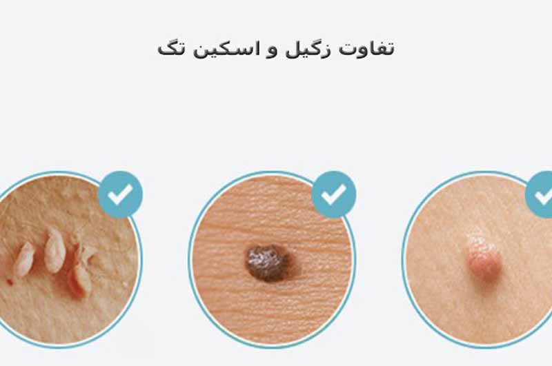 تفات زگیل تناسلی و اسکین تگ