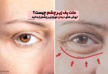 علت پف زیر چشم چیست؟ روش های درمان تورم زیر چشم را بدانید!