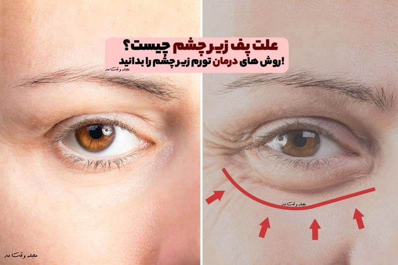 پف زیر چشم چیست؟ علل ایجاد و روش‌های موثر درمان تورم زیر چشم
