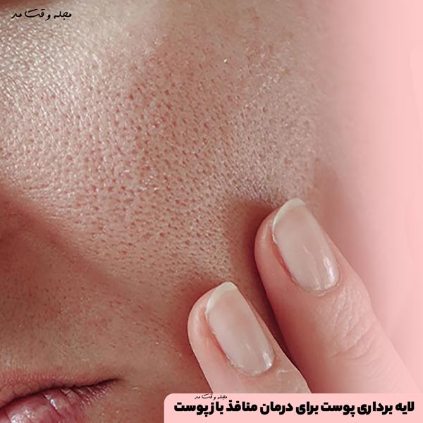لایه برداری پوست برای درمان منافذ باز پوست