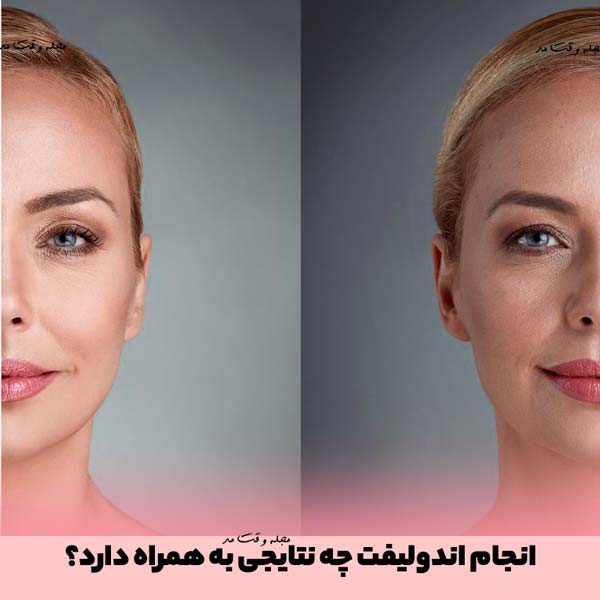 انجام اندولیفت چه نتایجی به همراه دارد؟