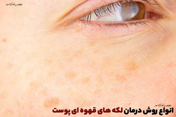 آموزش انواع روش درمان لکه قهوه ای