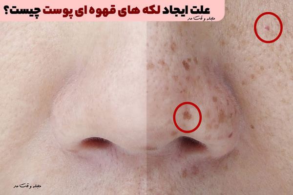 علت ایجاد لکه های قهوه ای پوست شامل نور خورشید و مواد آرایشی و ... است.