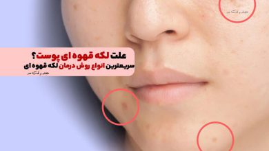 علت لکه قهوه ای پوست؟! سریعترین انواع روش درمان لکه قهوه ای