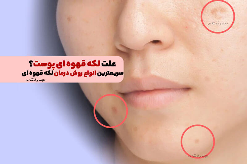 علت لکه قهوه ای پوست؟! سریعترین انواع روش درمان لکه قهوه ای