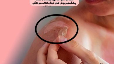 آفتاب سوختگی چیست؟ علت، پیشگیری و روش های درمان آفتاب سوختگی